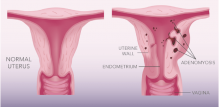 Adenomioza