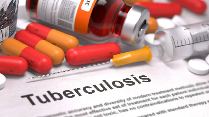 tuberkuloza
