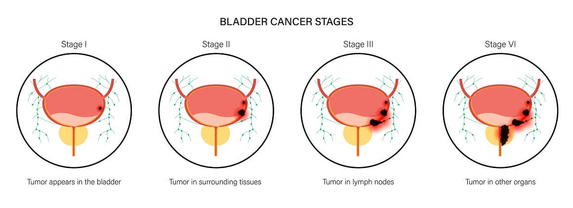 Stadij karcinoma mokraćnog mjehura - I, II, III, IV