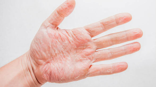 suha koža ruku