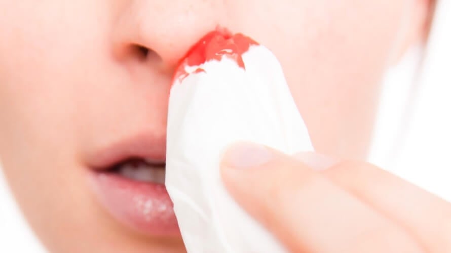 Obilna krvarenja iz nosa – uzroci i prevencija