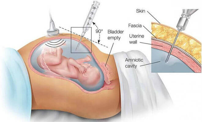 amniocenteza