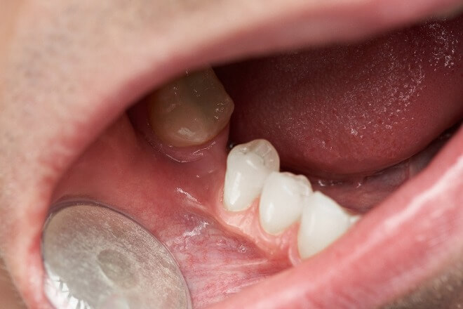 Dentalna-cista
