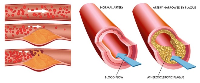 Masnoća u krvi – uzrok, simptomi i liječenje