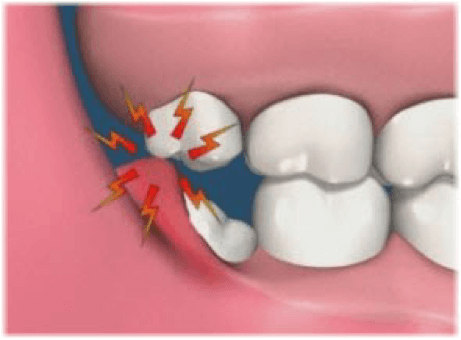bolovi u zglobovima nakon vađenja zuba