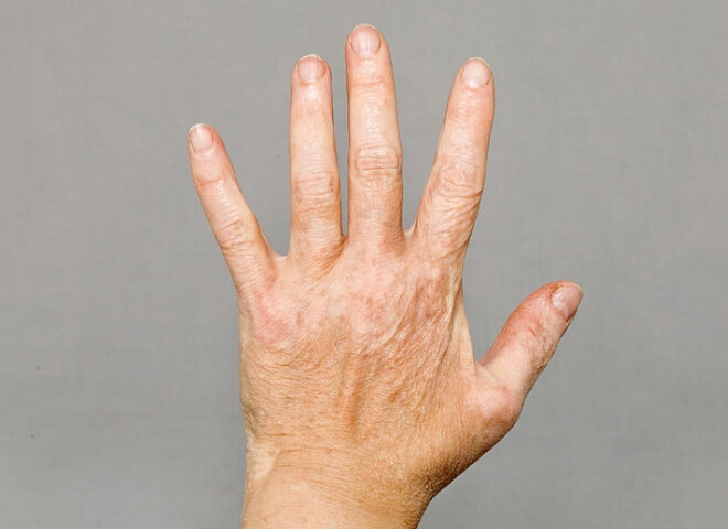 Vitiligo ruke
