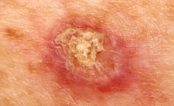 Planocelularni karcinom