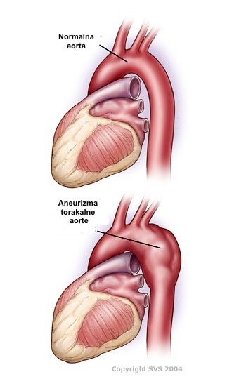 aneurizme aorte i hipertenzije