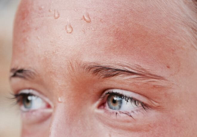 Prekomjerno znojenje čelo