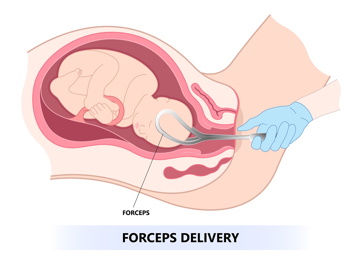 Porod na zadak - rizici i komplikacije