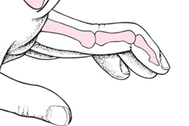 deformitet zgloba prstiju i bol