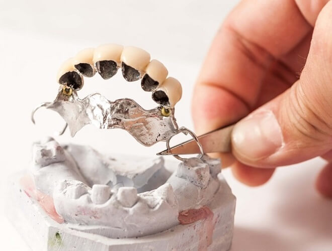 Metalokeramički most za zube