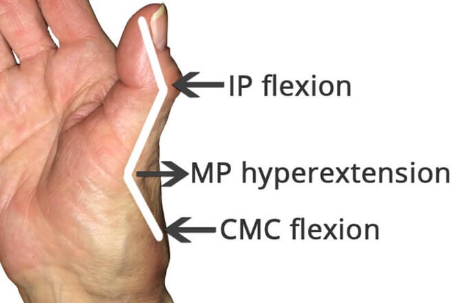 bolovi u zglobovima i fleksija prstiju