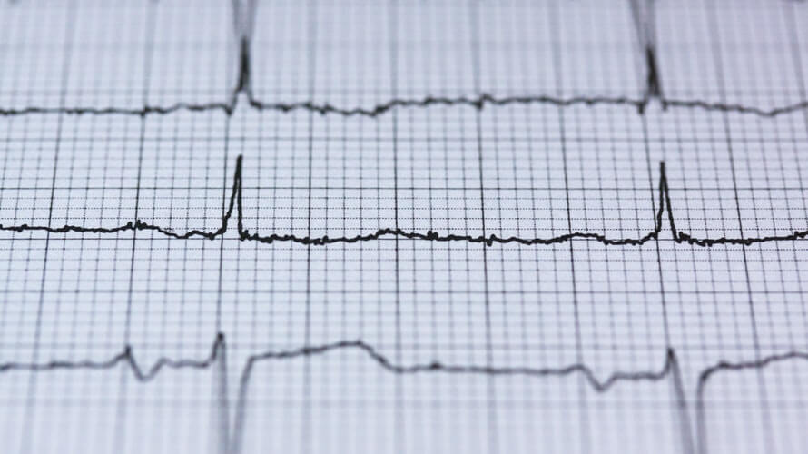 Kako smiriti aritmiju srca?
