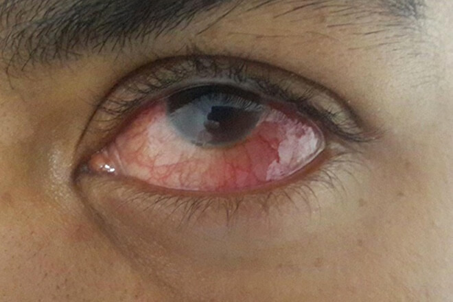 turbekuloza oka1
