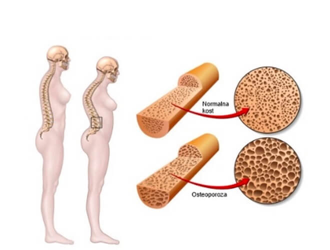 osteoporoza vs. normalna kost