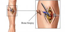otvorena biopsija