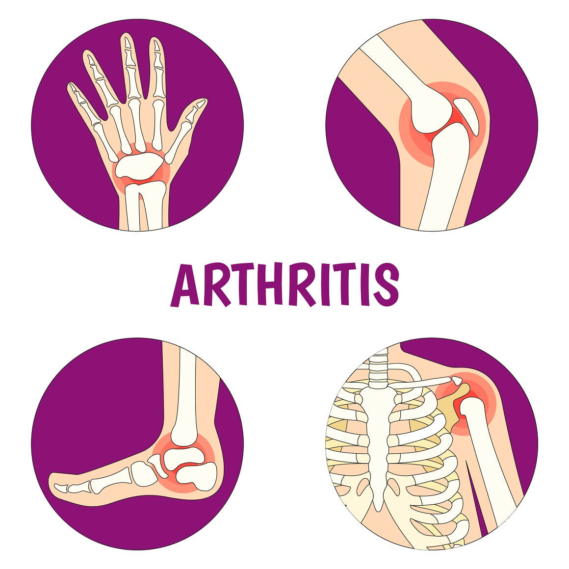 Artritis je bolest široke učestalosti diljem svijeta i broji više od 100 vrsta