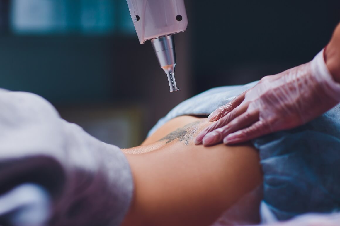 Lasersko uklanjanje tetovaža - iskustva i razina boli