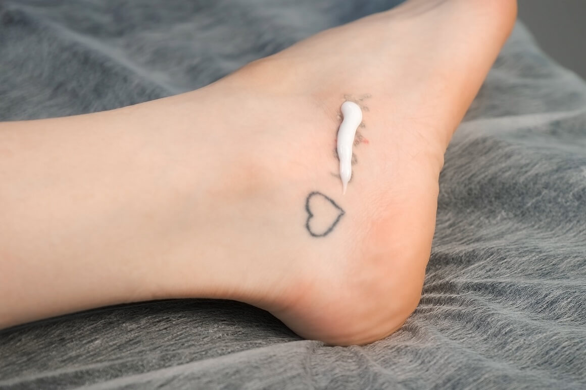 Lasersko uklanjanje tetovaža - kako njegovati kožu