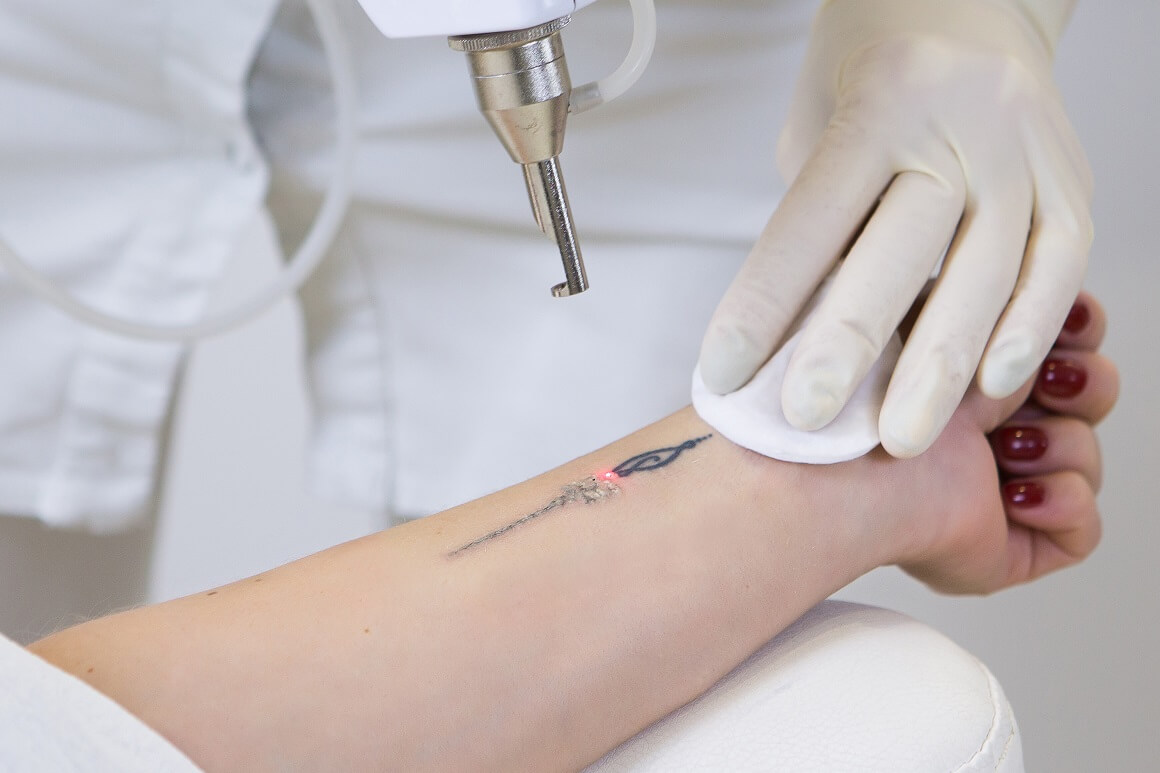 Lasersko uklanjanje tetovaža - kako se izvodi