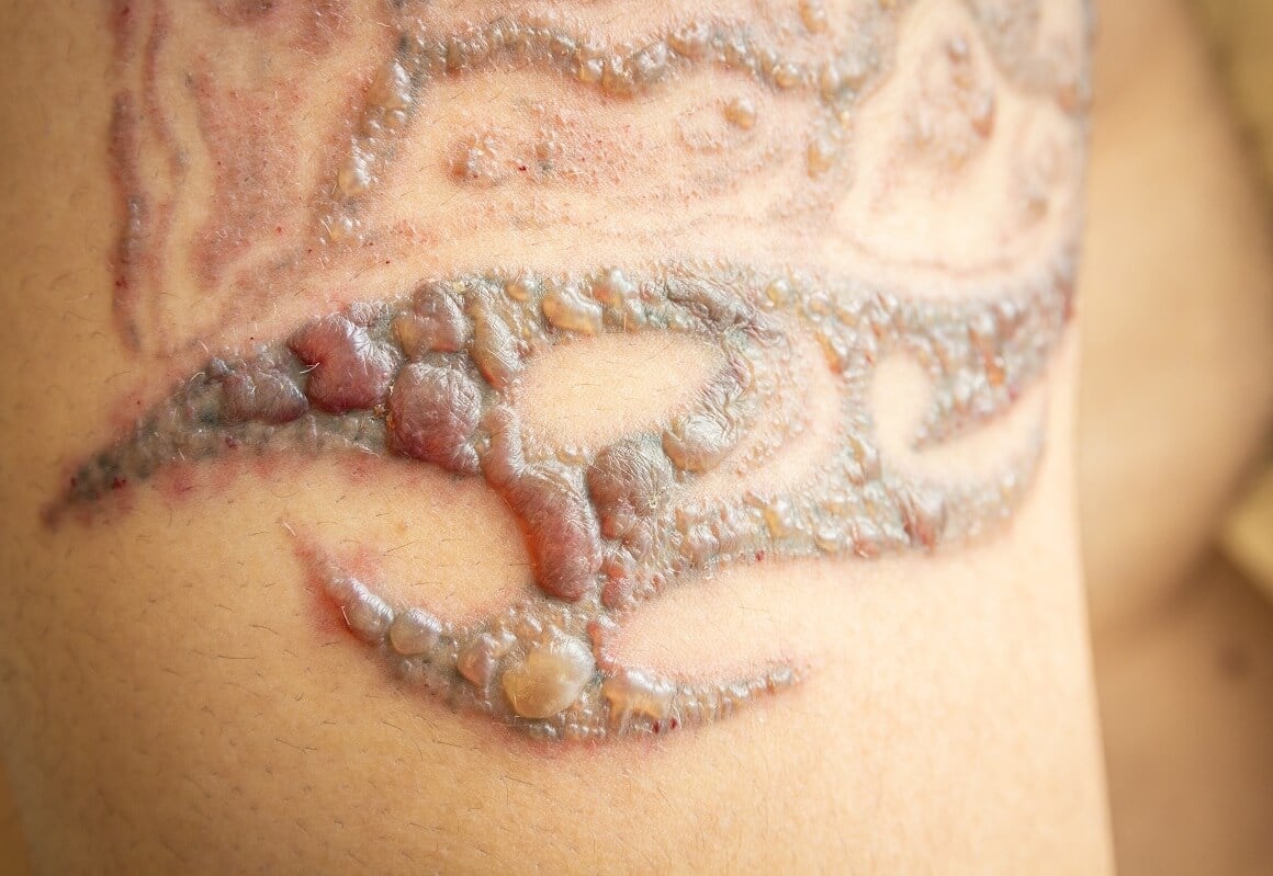 Lasersko uklanjanje tetovaža - nuspojave