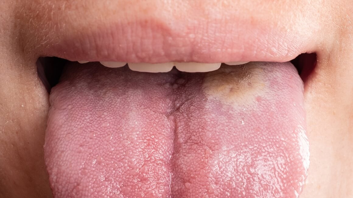 Rak jezika - simptomi