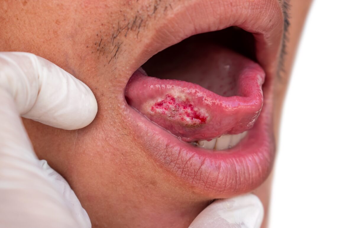 Rak oralnog dijela jezika