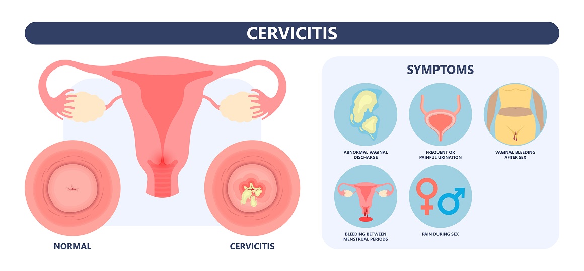 Upala vrata maternice (cervicitis) - simptomi