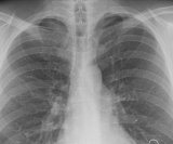 Akutni respiratorni distres sindrom