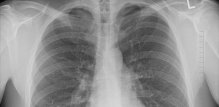 Akutni respiratorni distres sindrom