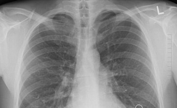 Akutni respiratorni distres sindrom