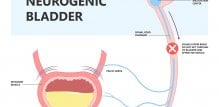 Neurogena (neuropatska) inkontinencija ili neurogeni mjehur