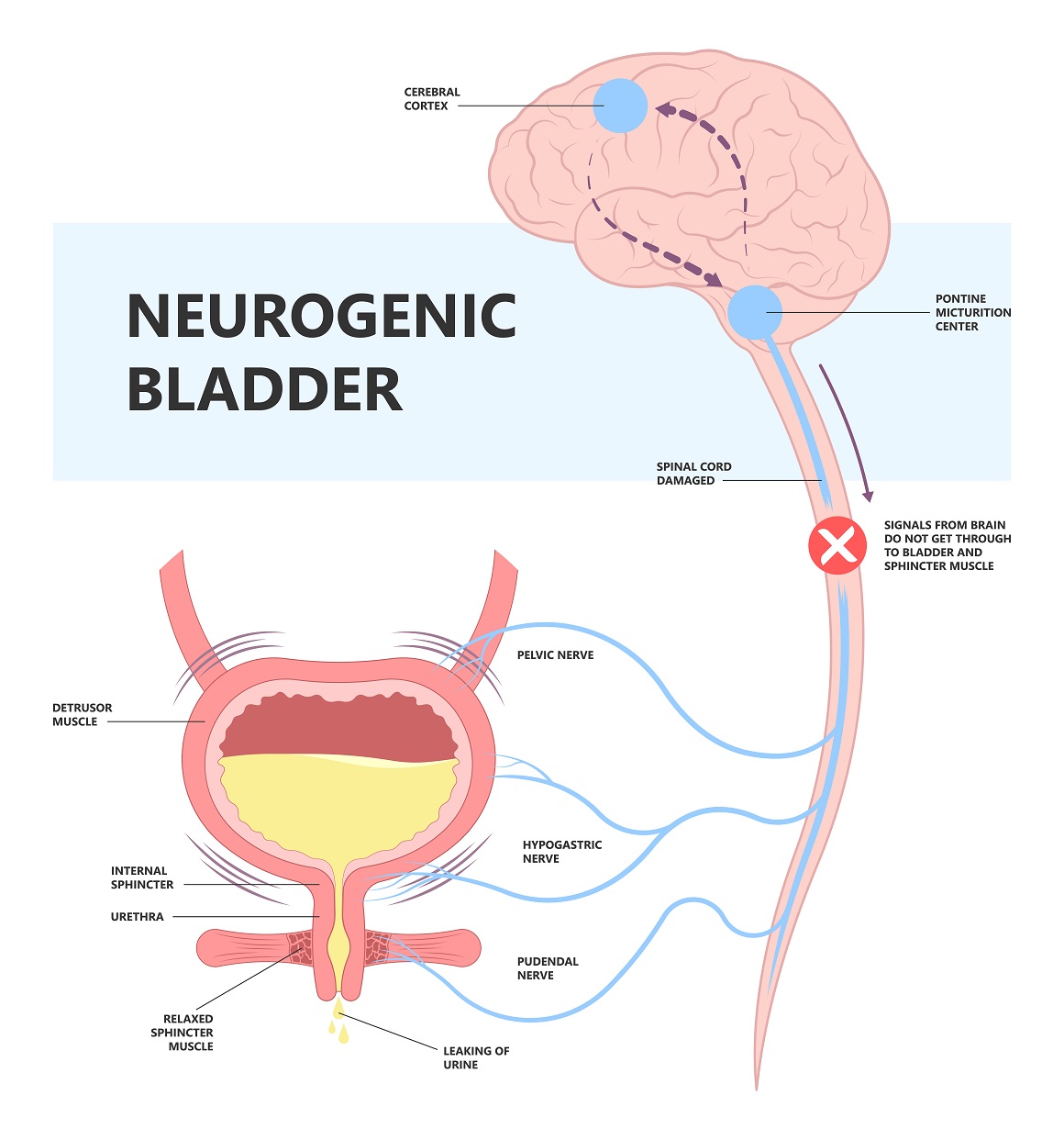 Neurogena (neuropatska) inkontinencija ili neurogeni mjehur
