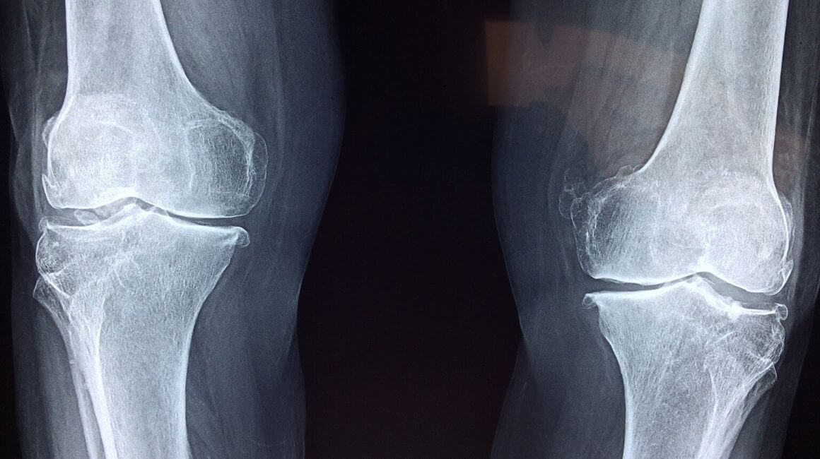 bol podliježe operaciji koljena bol u koljenu preko šalice