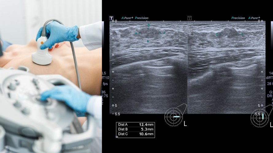 Ultrazvuk dojke