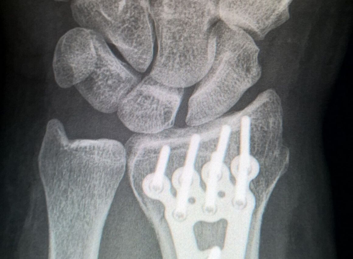 liječenje artroze nakon prijeloma radijalne kosti