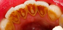 Zeodent - zubni kamenac