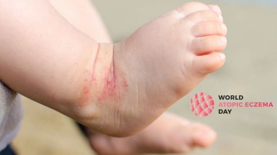 Svjetski dan atopijskog dermatitisa