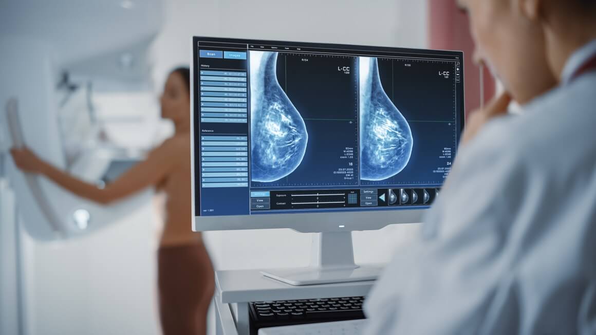 Na mamografiju se odaziva većina pozvanih žena