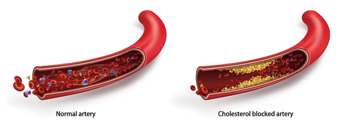 kako sniziti kolesterol bez lijekova