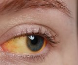 Hepatitis A