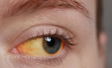 Hepatitis A