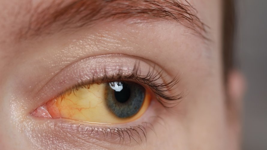 Hepatitis A