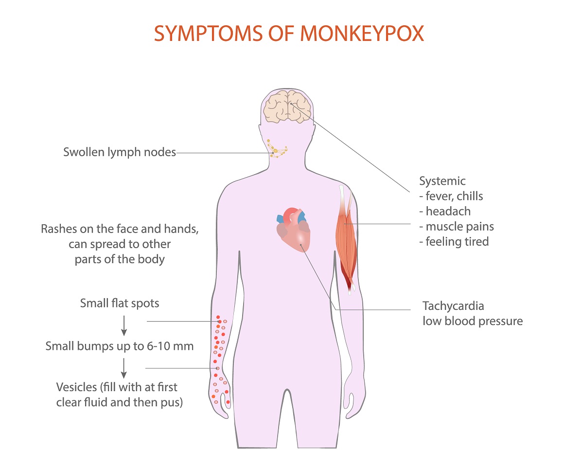 Majmunske boginje - simptomi