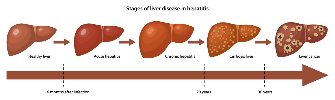Najgori hepatitis