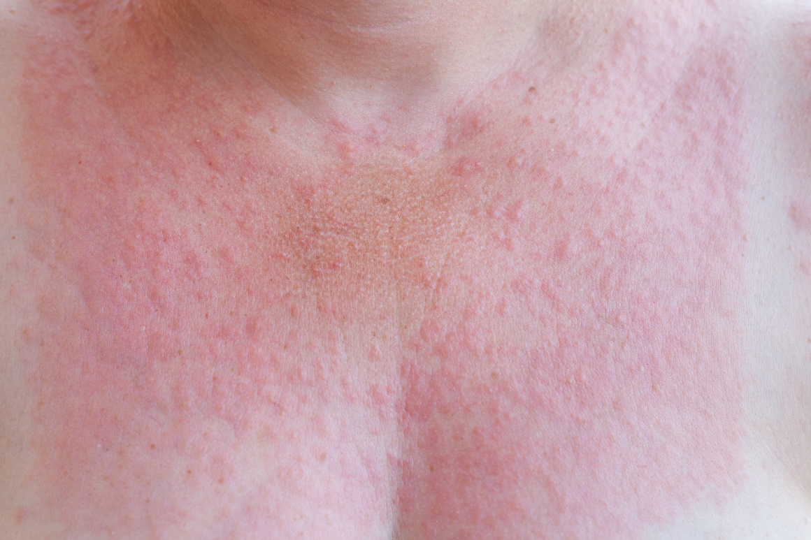 Simptomi alergije na sunce