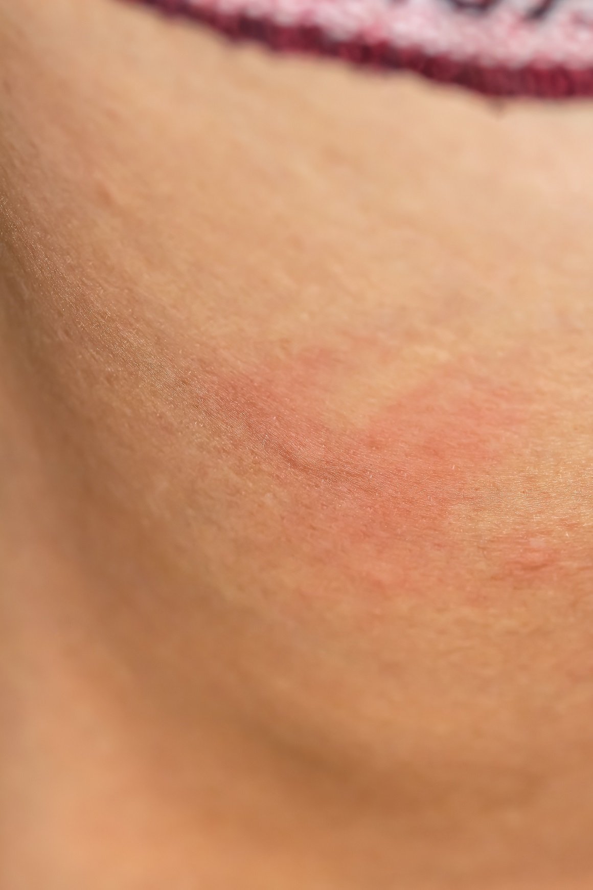 Ubod komarca - alergija