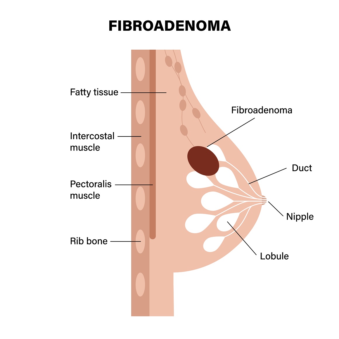 Fibroadenom dojke