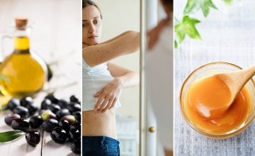 Prirodni lijekovi za psorijazu